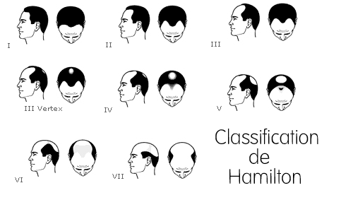 Classification de Hamilton, les diffrentes tapes de la calvitie